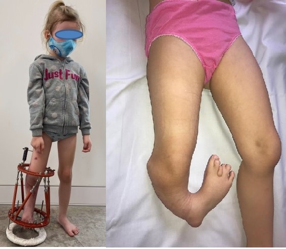 4-letnia Amelia operacja nogi degi - Szpital Kliniczny im. Wiktora Degi
