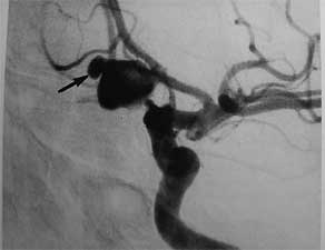 Obraz tętniaka olbrzymiego - tętniak olbrzymi